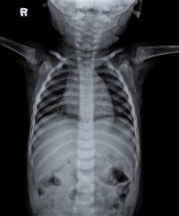 An x-ray of a child's torso.